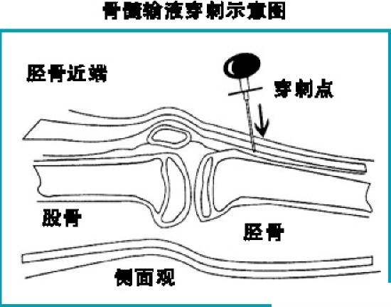 緊急輸液方式之骨髓內輸液